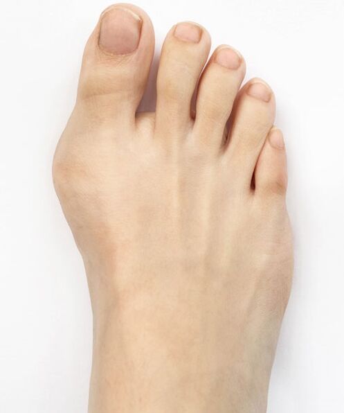 Hallux valgus vor der Anwendung des Hondro Sol Valgus-Sprays
