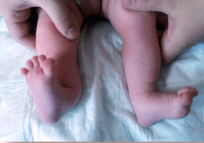 Valgus -Deformation bei Kindern Symptome