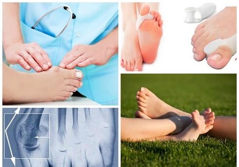 Behandlung der Valgus -Verformung