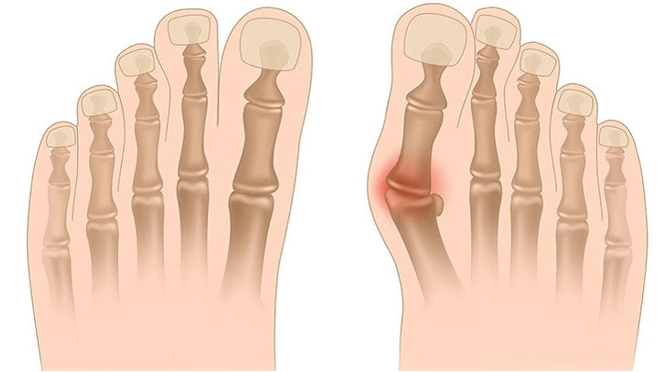 Behandlung der Valgus -Verformung