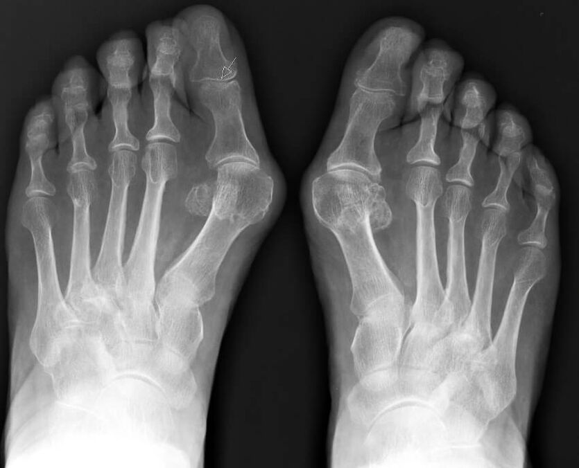 Röntgenaufnahme des Hallux valgus